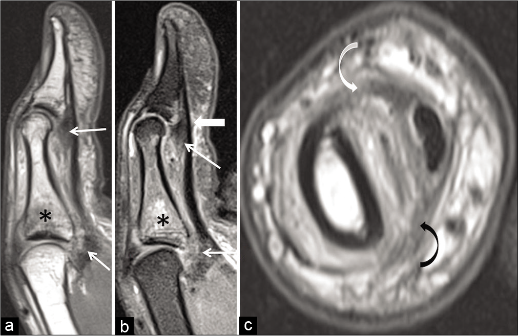 3T Magnetic Resonance Imaging of the Thumb-normal Appearances and ...