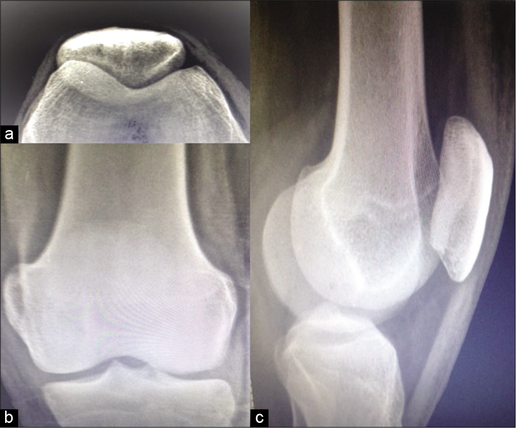 Case 1 – X-ray: (a) Skyline view, (b) lateral projections and (c) frontal of the patella of the right knee do not reveal any significant cortical erosion or irregularity.