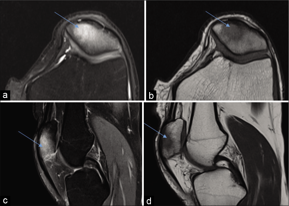 Case 1 – Magnetic resonance imaging dated January 11, 2018 – PDFS axial (a) and sagittal (b) and sagittal (c) and images and T1 axial (d) images reveal altered marrow signal along patella which appears hyperintense on PDFS images and hypointense on T1 weighted image (arrows).