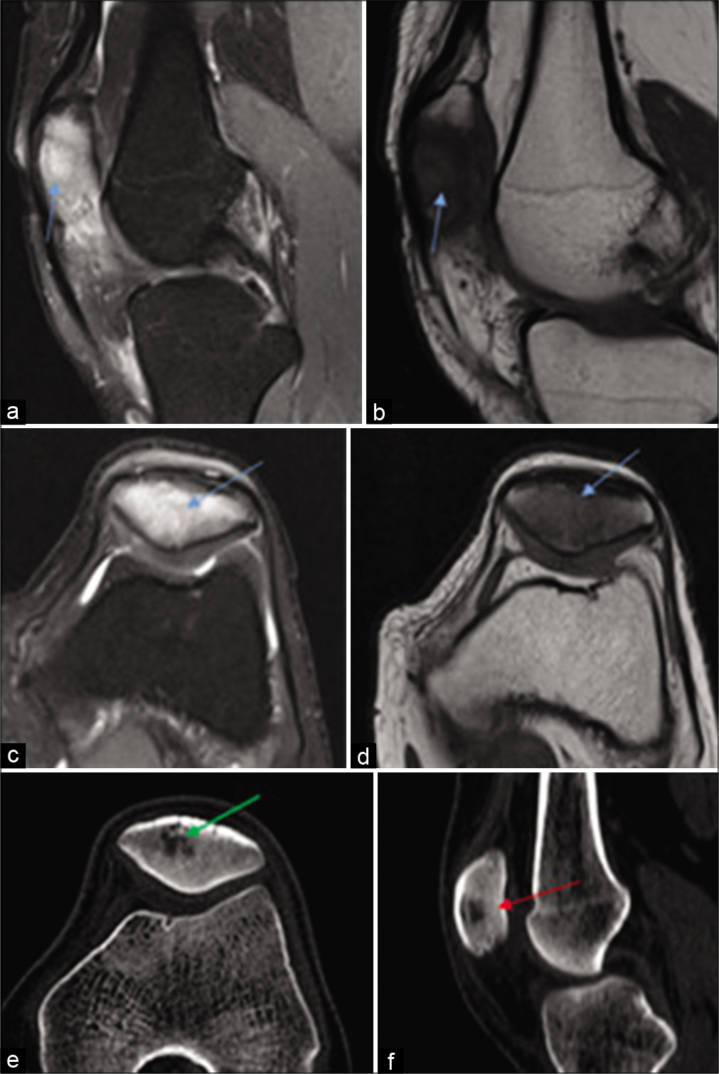 Case 1 – Sagittal PDFS and T1 (a, b), axial PDFS (c) and T1 (d) and CT scan (bone window) axial (e) and sagittal sections (f) reveal progression, in the form of hyperintense marrow signals involving the entire patella (blue arrow a and b) and CT scan reveals the appearance of a focal lytic lesion involving the patella with fresh appearance of adjacent sclerosis (green and red arrow).