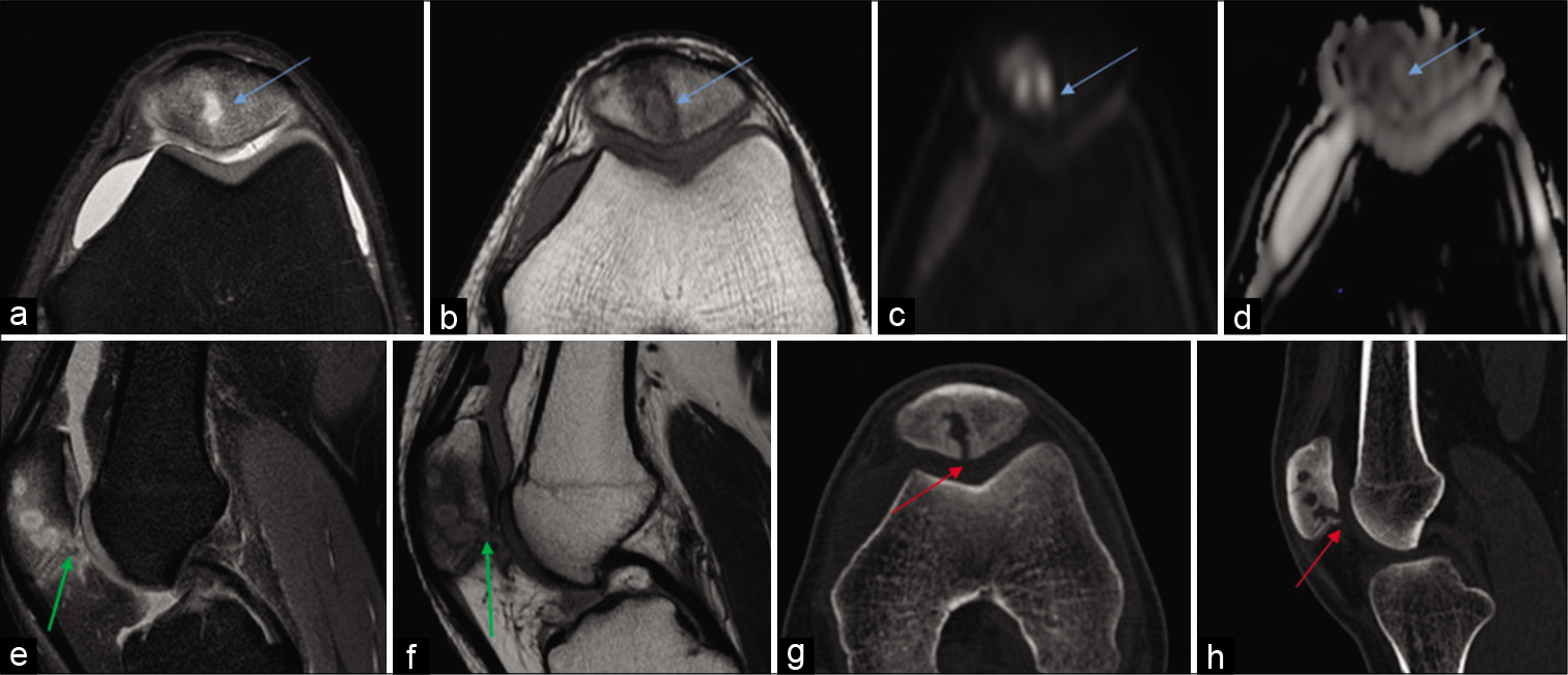 Case 1 – Axial PDFS (a), axial T1-weighted (b), diffusion-weighted imaging and apparent diffusion coefficient (c,d), sagittal PDFS and T1-weighted (e and f) images and CT scan (bone window axial [g] and sagittal [h]) reveals the presence of an altered signal intensity focal lesion involving patella with central restriction (blue arrows), focal cortical breach along patellar facet (green arrow) seen clearly on CT images (red arrow).