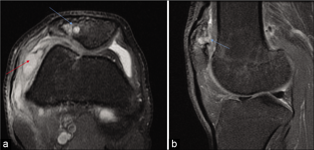 Axial PDFS (a), sagittal (b) PDFS images reveal well defined lytic lesion involving lateral half of patella with loss of articular cartilage and breach in cortical surface (marked by red arrow). Associated changes of synovitis are apparent along the lateral aspect of the knee joint.