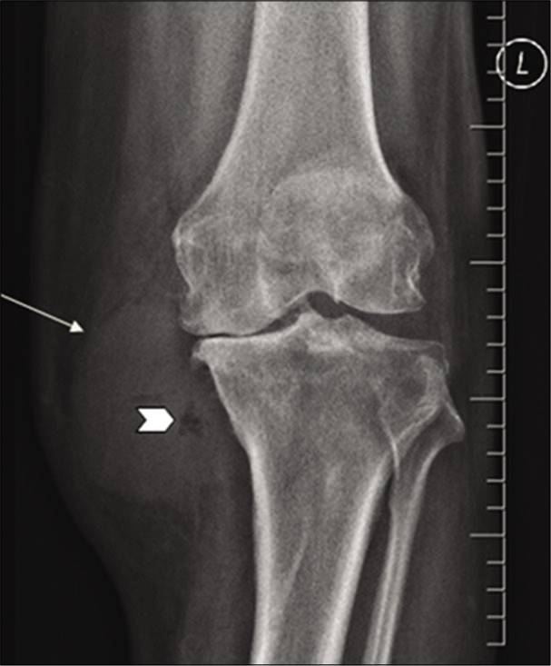 Plain radiograph of the left knee joint showing a well- defined radio-opacity (arrow) along the medial border of the joint and proximal tibia with few air foci within it (arrowhead). Note the degenerative changes in the joint, predominantly in the medial compartment.