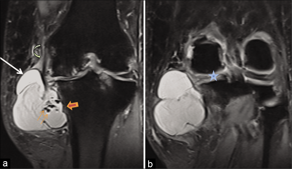 Magnetic resonance imaging TRIM coronal images showing (a) a large complex cyst (arrow) with air pockets (thin arrows), tibial cortical erosion (arrowhead), and edema, femoral attachment of medial collateral ligament was seen (curved arrow); however, the tibial attachment was indistinct (not shown). (b) Macerated medial meniscus with articular cartilage loss and subchondral edema is also seen (star).