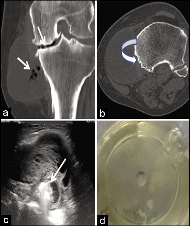 (a,b) Coronal and axial computed tomography images showing tibial cortical erosion (curved arrow), air foci within the lesion, and medial joint space. (c) Ultrasound showing the complex nature of the cyst as thick septations and air pockets (arrow) within it. (d) Ultrasound-guided aspirate from the lesion showing clear yellowish gelatinous material.