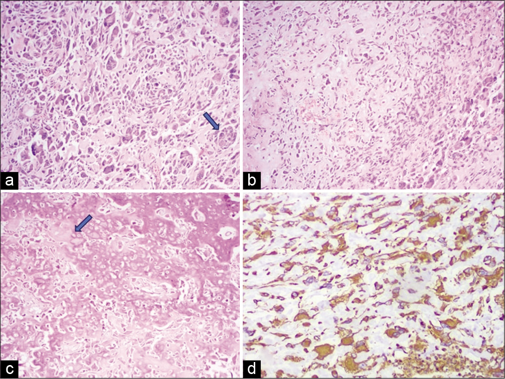 Histopathological examination images of the resected mass – hematoxylin and eosin stain, Image a (20×) and Image b (10×) showing malignant pleomorphic bizarre cells (shown by arrow) with intervening areas of dense hyalinized fibrocollagenous stroma and osteoid material. Image c is showing malignant osteoid cells laying in the form of lacy and thick trabecular osteoid material with hyperchromatic atypical cells within. Image d on immunohistochemistry the cells was immunopositive for vimentin and immunonegative for CD117, CD34, epithelial membrane antigen, desmin, myogenin, CD68, calretinin, S100, HMB-45, and leukocyte common antigen.