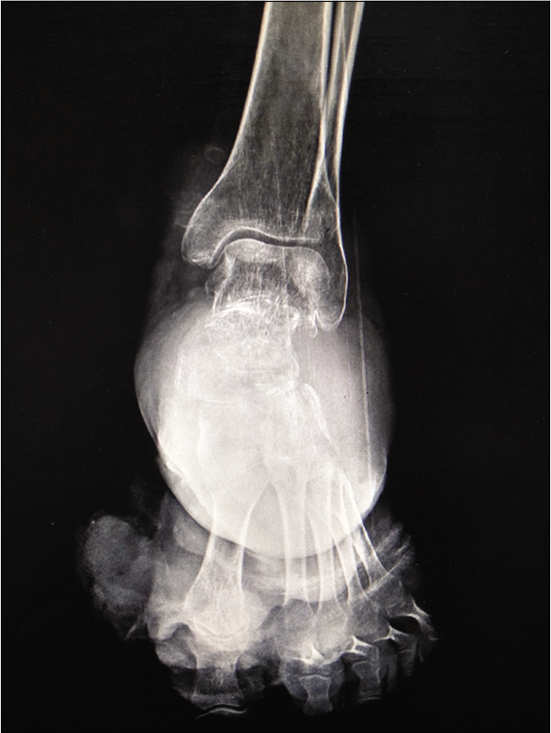 Radiograph of the left foot with ankle showing a large soft-tissue lesion with lytic expansile destruction of calceneum, talus, cuboid, and cuneiforms.