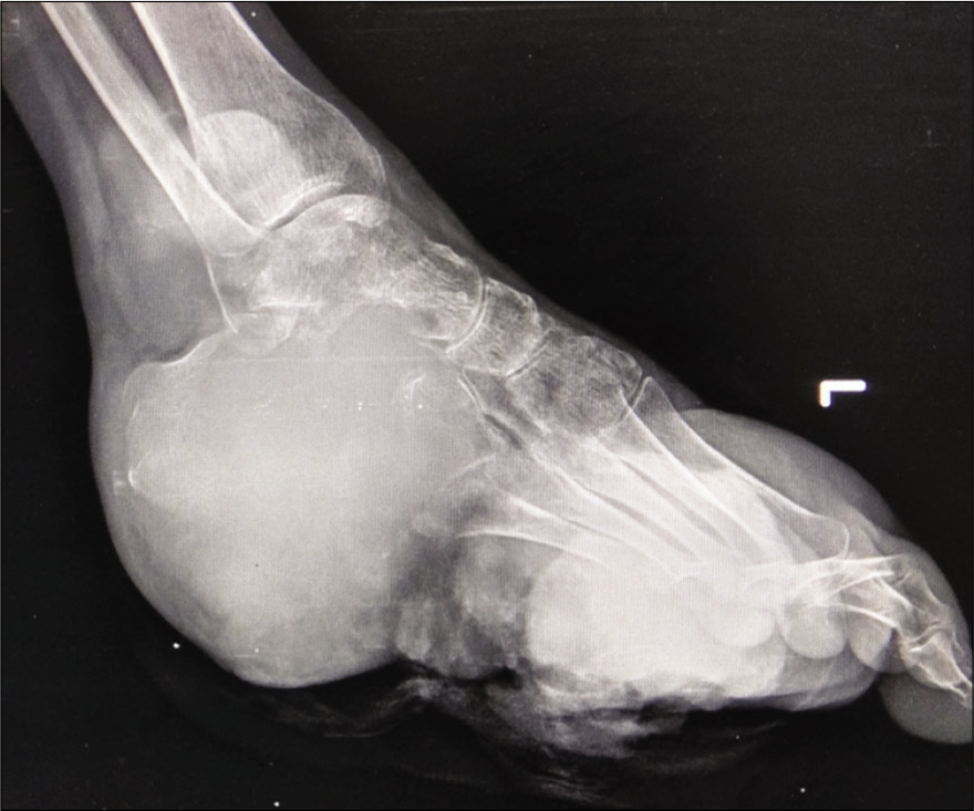 Lateral radiograph of the left foot with ankle showing a large soft-tissue lesion epicentered at calcaneum with its lytic expansile destruction and associated soft-tissue component.