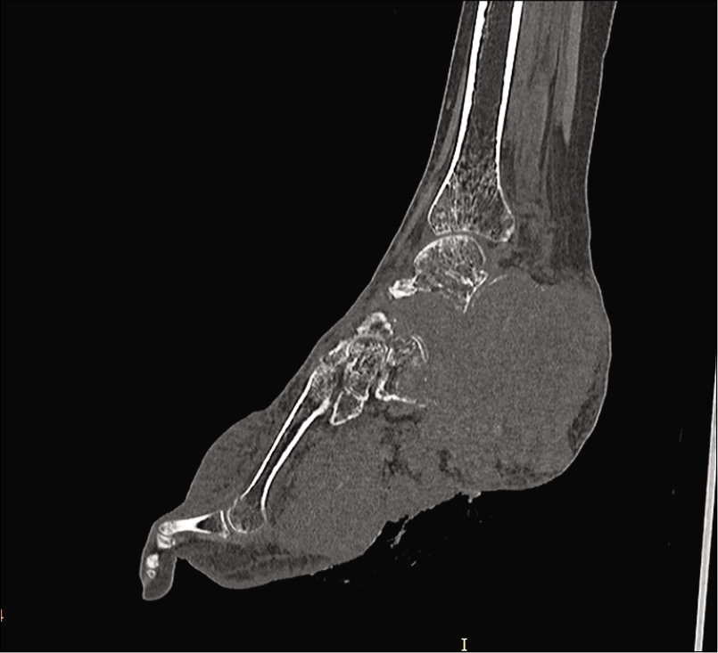 Non-contrast-enhanced computed tomography ankle and foot showing an ill-defined lytic lesion involving the calceneum causing its complete destruction with cortical breach and associated large soft-tissue component. Lytic destruction of talus, cuboid, and lateral cuneiform is also seen.