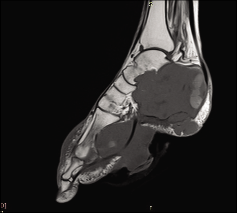 Sagittal T1-weighted image showing an ill-defined lobulated hypointense lesion epicentered in calcaneus with complete destruction of calceneum, talus, cuboid, and lateral cuneiform. Inferiorly, the lesion is reaching up to skin surface with splaying of flexor tendons.