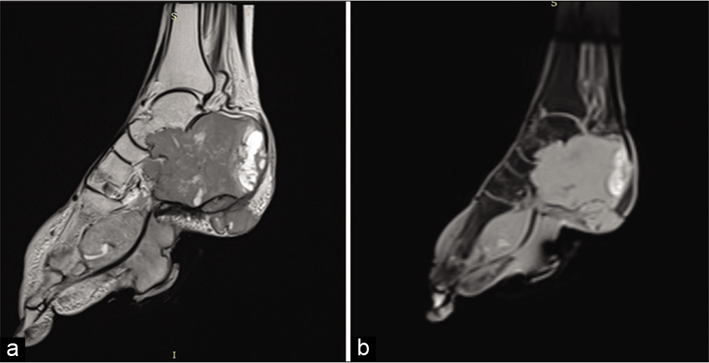 Sagittal T2 (a) STIR (b) weighted images showing hyperintense signal in the lesion.