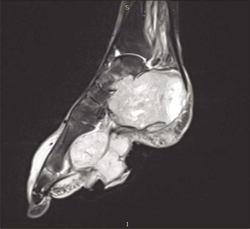 Post-contrast T1-weighted sagittal image showing intense heterogeneous enhancement in the lesion.