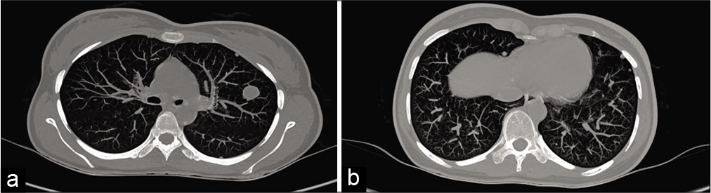 (a and b) CT chest showing multiple randomly distributed soft-tissue nodules suggestive of metastasis.