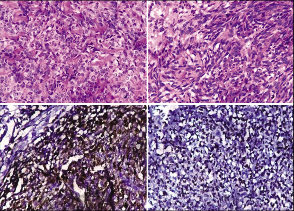 Histological assessment (×200) showing large epithelioid and spindle cells arranged in cords, clusters, and as single cells within a myxoid to hyalinized stroma. Immunohistochemistry shows positivity to S-100 and CD99.