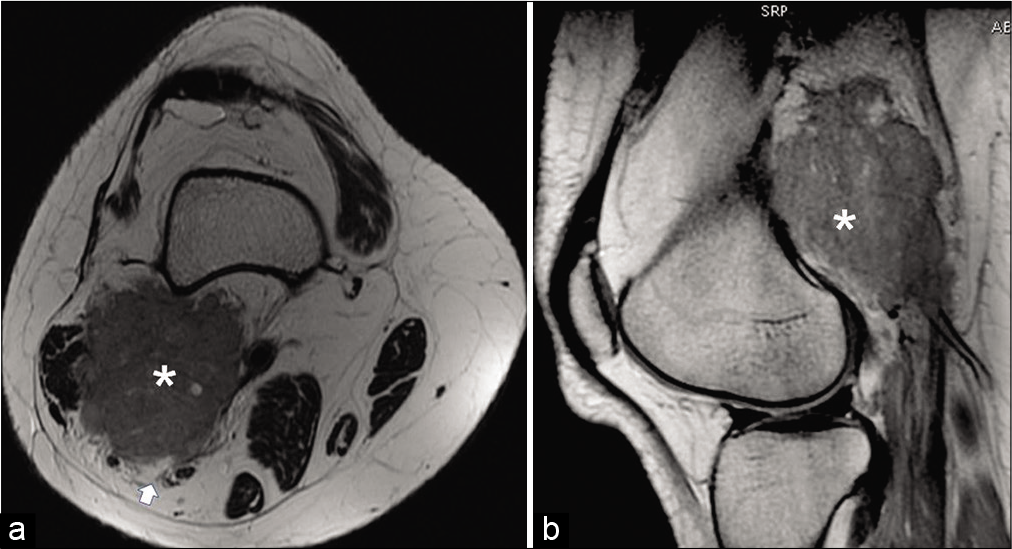 Axial T2-weighted (a) and sagittal proton density-weighted (b) images reveal iso to slightly hyperintense (relative to muscle) lesion (asterisk) with irregular spiculated margins abutting the posterior cortex of femur without any cortical erosion and showing contiguous infiltration into the adjoining distal biceps femoris muscle. The lesion is causing splaying of the neurovascular bundle (arrow) (acquisition protocol – 1.5 Tesla scanner [GE Signa HDxt], 4 mm slice thickness, 1.5 mm interslice gap, TE for T2-weighted image [T2WI] – 91, TR for T2WI 4580, TE for platelet distribution width [PDW] – 19.7, TR for PDW – 2000).