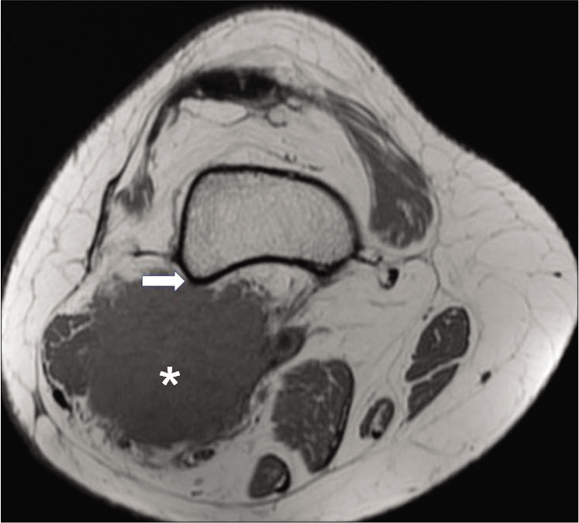 A 51-year-old woman who presented with severe pain in the right popliteal fossa for the past 2 years. Axial T1-weighted image reveals iso-intense (to muscle) lesion (asterisk) in the posterior aspect of the lower thigh and popliteal fossa with irregular spiculated margins abutting the posterior cortex of femur (arrow) without any cortical erosion (acquisition protocol – 1.5 Tesla scanner [GE Signa HDxt], 4 mm slice thickness, 1.5 mm interslice gap, TE – 8.4, TR – 820).