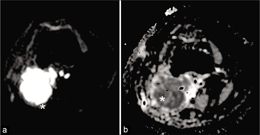 On axial diffusion weighted (a) (at b value 1000 s/mm2) and apparent diffusion coefficient (b) sequences: Lesion (asterisk) reveals internal hyperintense (a) and hypointense (b) signals, respectively, representing diffusion restriction and high cellularity (acquisition protocol – 1.5 Tesla scanner [GE Signa HDxt], 4 mm slice thickness, 1.5 mm interslice gap, b value for diffusion-weighted imaging (DWI) – 1000, TE for DWI – 82.9, TR for DWI – 3600).