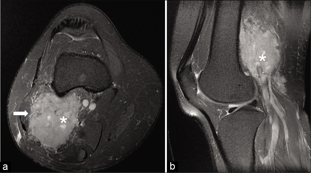 Giant Glomus Tumor Of The Knee Mimicking Soft Tissue Sarcoma Indian