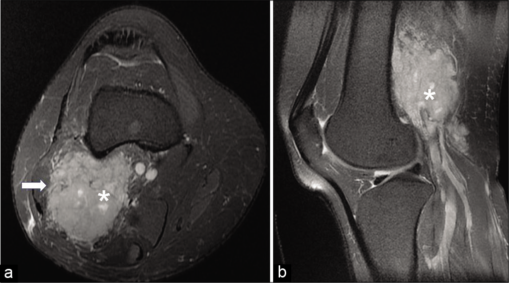 On axial (a) and sagittal proton density (b) fat-saturated images, the lesion (asterisk) appears hyperintense and insinuating into the biceps femoris muscle (arrow) (acquisition protocol – 1.5 Tesla scanner (GE Signa HDxt), 4 mm slice thickness, interslice gap for axial PDFS 1.5 mm, interslice gap for sagittal PDFS 1.0 mm, TE for axial PDFS 51.1, TE for sagittal PDFS 43.1, TR for axial PDFS 3080, TR for sagittal PDFS 2480).