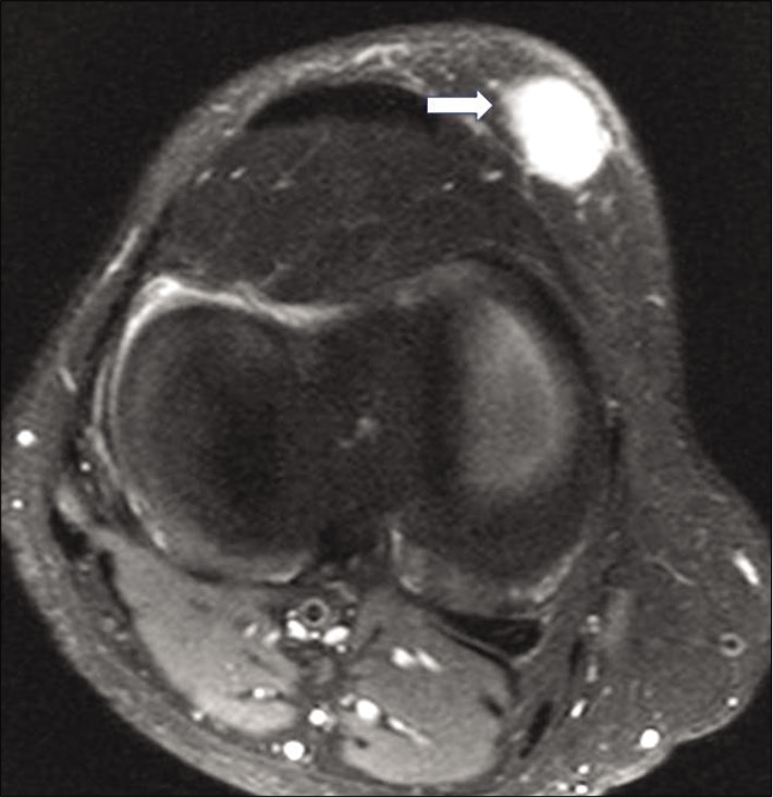 On axial proton density fat-saturated sequences, typical extradigital glomus tumor at the knee (a 24-year-old male patient presented with anterior knee pain, tenderness, and swelling) appears as well-circumscribed oval-shaped small homogenously hyperintense lesion (arrow) in superficial subcutaneous soft tissues. This is in contrast to our case which presented with infiltrative margins, deep location, large size, and heterogeneous mildly hyperintense T2 signals (as shown in Figure 2a and b) (acquisition protocol – 1.5 Tesla scanner [GE Signa HDxt], 4 mm slice thickness, interslice gap for axial PDFS 1.5 mm, TE - 51.1, TR – 3080).