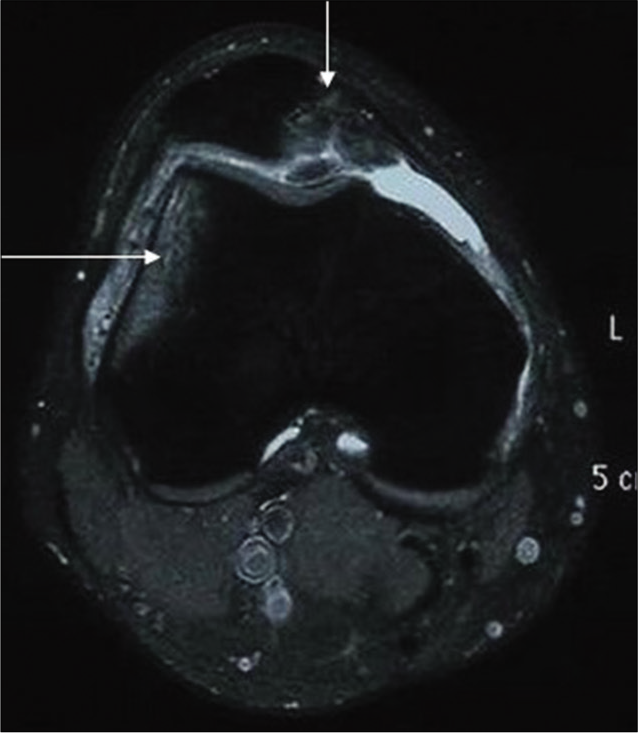 Axial PD fat suppressed image reveals bone contusion involving lateral femoral condyle in a 20 years old wrestler (wt-90 kg, ht-180 cm, and duration of training 5 years) (long arrow) and osteochondral fracture along the medial facet of the patella (short arrow) suggesting a possibility of transient patellar dislocation. The injury occurred in competition and during defense position. He took conservative treatment for 3 months and was relieved.