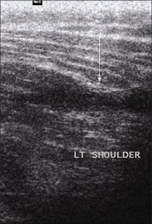 US image reveals Grade II Strain of left deltoid muscle of a 19 years old wrestler (wt-80, ht-168 cm, and duration of training for 8 years), shows hypoechoic area (arrow) in the region of its posterior attachment. The patient sustained this injury during training (hard wrestling) in a defensive position (take down). He took conservative treatment for 1 month after which he got symptomatic relief. He did not report for a follow-up scan.