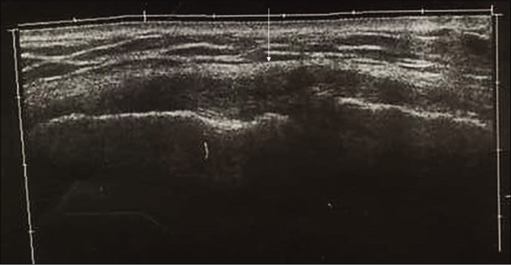 Panoramic US image of 21 years old wrestler (wt-60 kg, ht-165 cm, and duration of training 7 years), shows thickening and hypoechogenicity of the medial collateral ligament (arrow). The injury occurred during training (hard wrestling) in defense position. He got complete symptomatic relief with 15 days of conservative therapy.