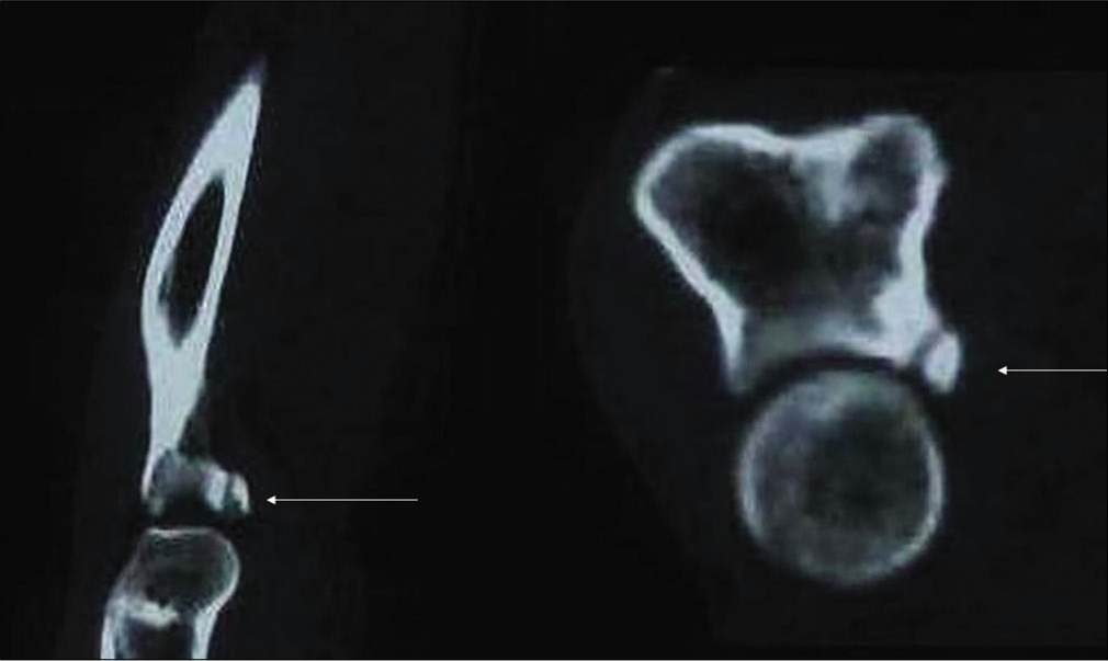 Sagittal and coronal reconstructed computed tomography images of Rt elbow of a 20 years old wrestler (wt-75 kg, ht-153 cm, and duration of training for 7 years) show a chip fracture of coronoid process of Rt ulna (arrow). The wrestler sustained this injury during practice (hard wrestling) in attack position.