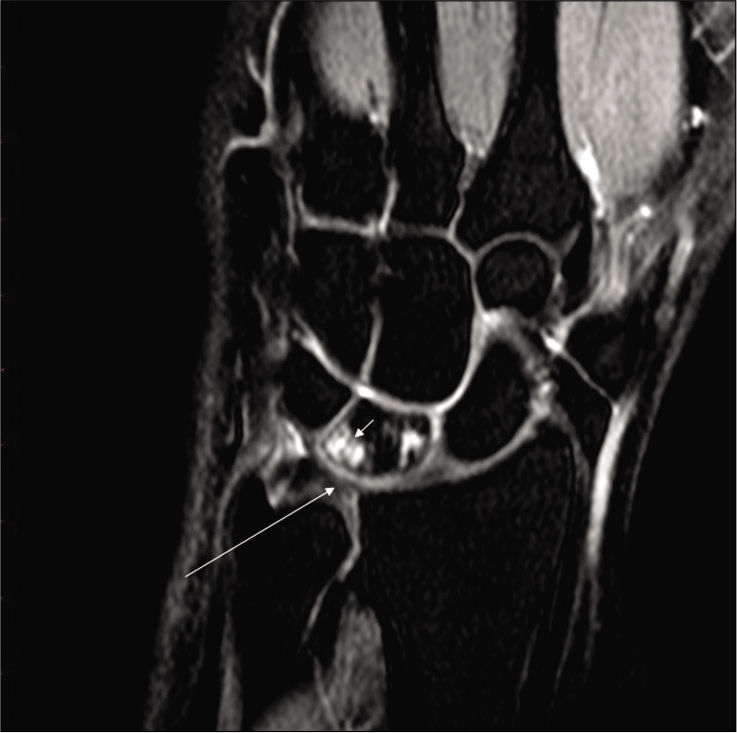 Coronal PD weighted fat-suppressed image of the left wrist reveals negative ulnar variance with a contusion of lunate (arrowhead) and degeneration of TFCC (long arrow) in a 20 years old wrestler (wt-66 kg, ht-171 cm, and duration of training for 5 years). The wrestler had multiple episodes of pain involving his left wrist, for which he would just take conservative treatment with relief.