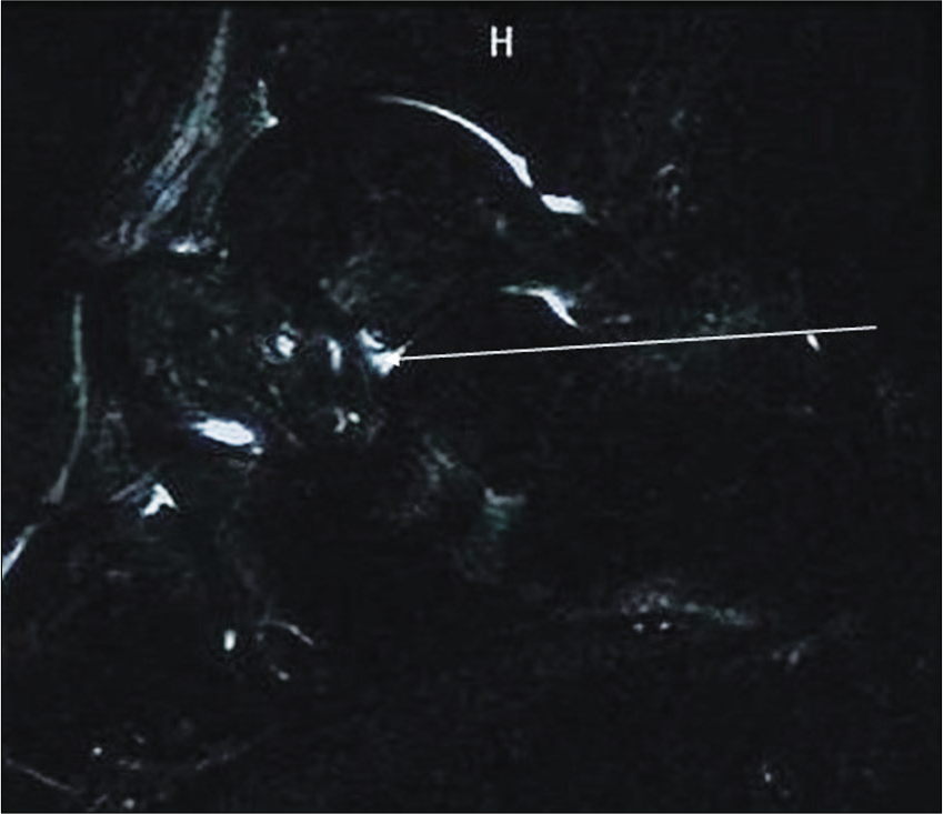 STIR Image of a 19 years old wrestler (wt-62 kg, ht-171 cm, and duration of training 3 years) shows altered signal intensity in the region of sinus tarsi (long arrow). There is also mild effusion in the subtalar joint space. The wrestler sustained this injury in a practice session (drill).