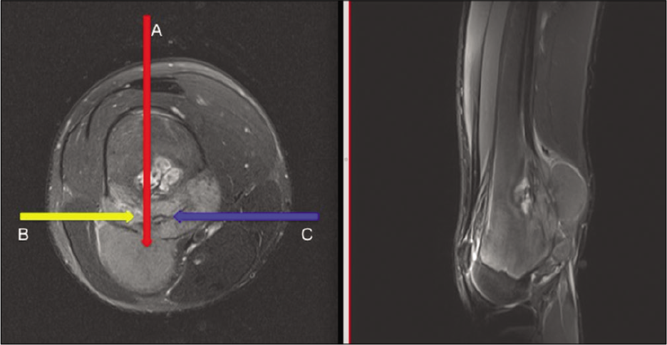 Image of the femoral tumor with biopsy routes (A, B, and C).