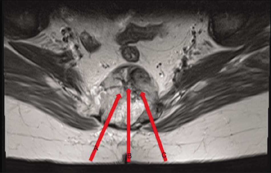Image of the spinal tumor with biopsy routes (A, B, and C).