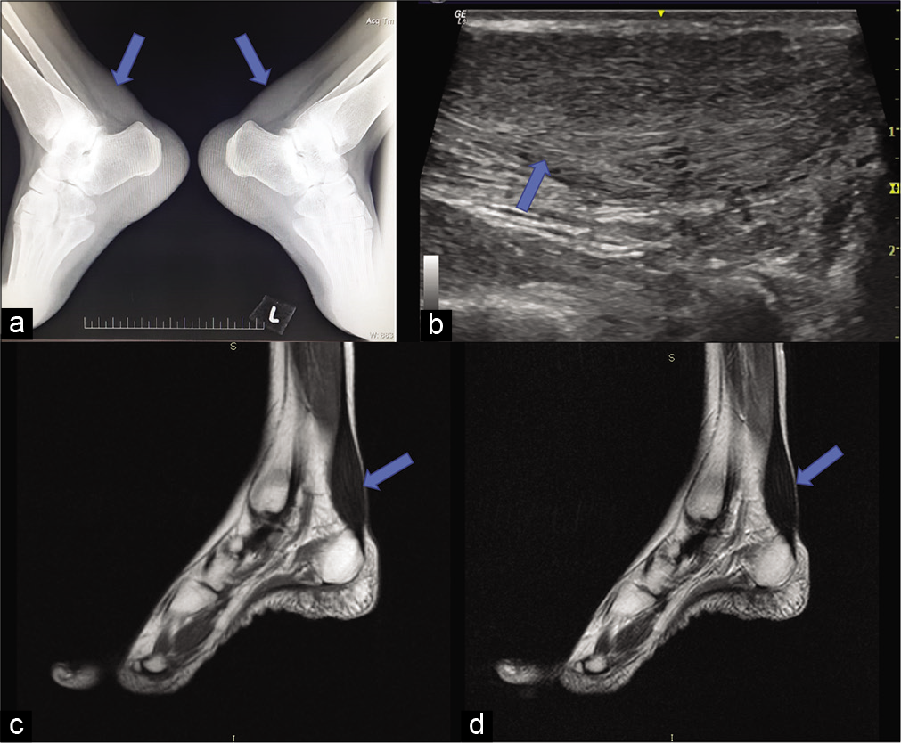 Imaging of the ankles showing enlarged Achilles tendon with obliteration of the Kager’s fat pad. Plain lateral radiographs of both ankle (a) obliteration of retro-calcaneal fat pad by soft-tissue density, without calcification. (b) USG sagittal image shows thickening and bilaterally symmetric hypoechoic infiltration and loss of normal fibrillary architecture. (c and d) MRI, T1 and T2 sagittal image of ankle showing enlarged tendon (arrows).