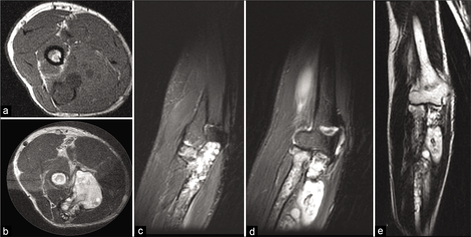 The patient 2–25 Y/F with gradually increasing swelling at the elbow for 6 months. Image 2 axial T1W (a) T2W (b) coronal STIR (c and d) and T2W (e) magnetic resonance imaging images at the elbow reveal ill-defined, T1 hypointense and heterogeneously T2W hyperintense lesions involving the proximal radius and ulna with a breach in the ulnar cortex and extension of the cystic lesion into the adjacent soft tissues.