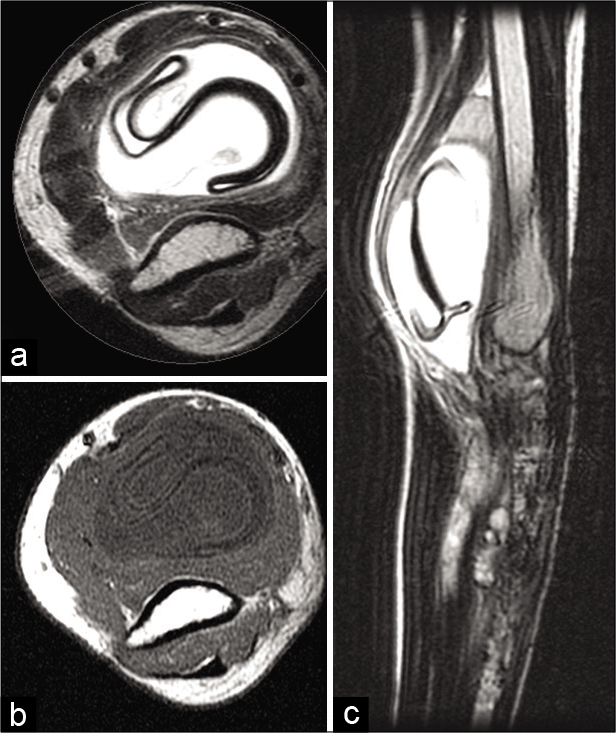 Same patient as Figure 2. Axial T2W (a), T1W (b), and sagittal T2W (c) images at the humeral level reveal a well-defined cystic lesion showing the characteristic “floating membrane” sign.