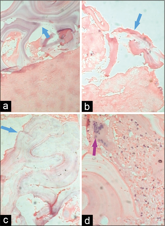 Histopathology images from Patient 1, H&E stain. Image a, b, c at low power field (×10) reveal hydatid cyst wall consisting of the avascular eosinophilic laminated chitinous membrane (blue arrow). Image d at high power field (×40) shows a foreign body giant cell reaction (purple arrow) with an area of hemorrhage and necrosis.
