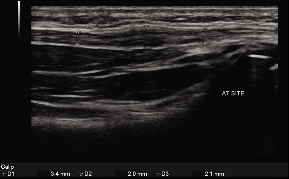 Gray scale ultrasound image showing thickened hypoechoic ulnar nerve measuring 3.4 mm (between calipers) at the site of anterior transposition. Proximally and distally, the nerve is normal and measures 2.0 mm and 2.1 mm, respectively.