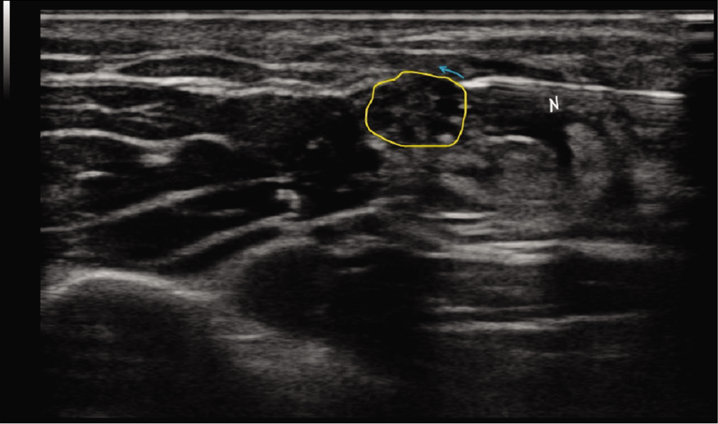 Transverse section of the nerve at the site of pathology (outlined in yellow) showing the needle (N) in place just before injecting the solution. The blue arrow depicts the projected trajectory of the solution in a bevel up position.