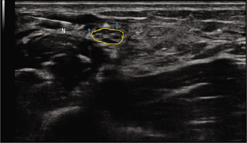 Transverse section of the nerve at the site of pathology (outlined in yellow) showing the needle (N) and the injected solution (blue arrows) as an anechoic sliver of fluid around the nerve epineurium.