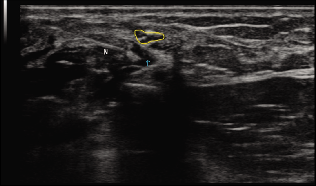 Transverse section of the nerve at the site of pathology (outlined in yellow) showing the needle (N) and the injected solution (blue arrow) below the nerve, thus separating it from the surrounding tissues from all sides.