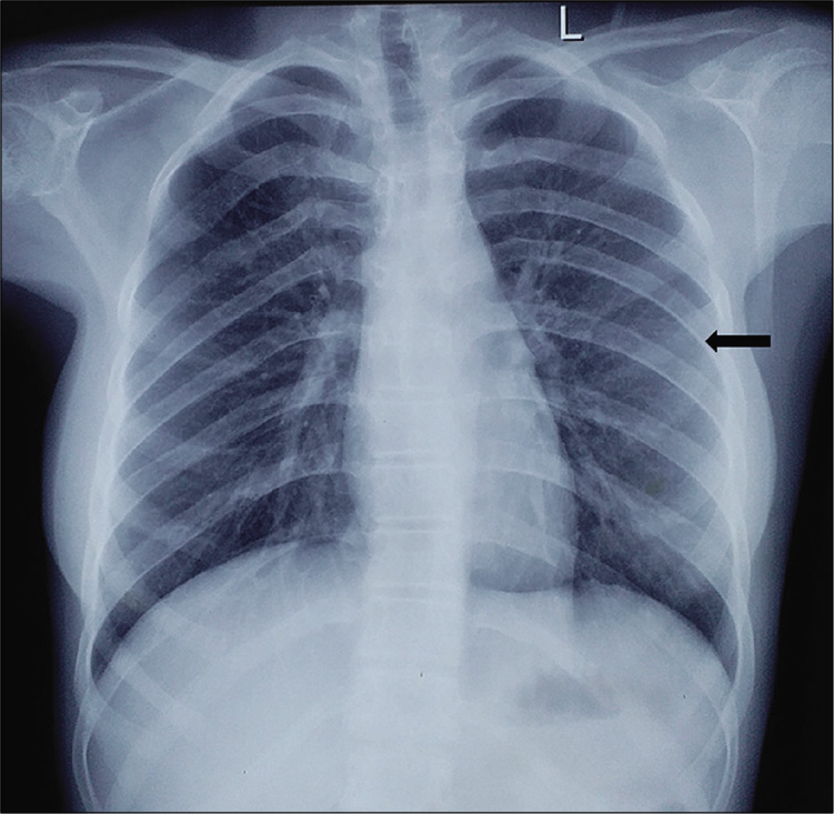 gorlin goltz syndrome