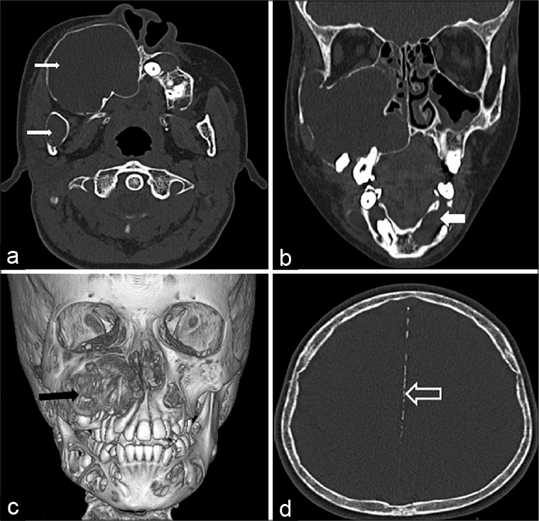 gorlin goltz syndrome