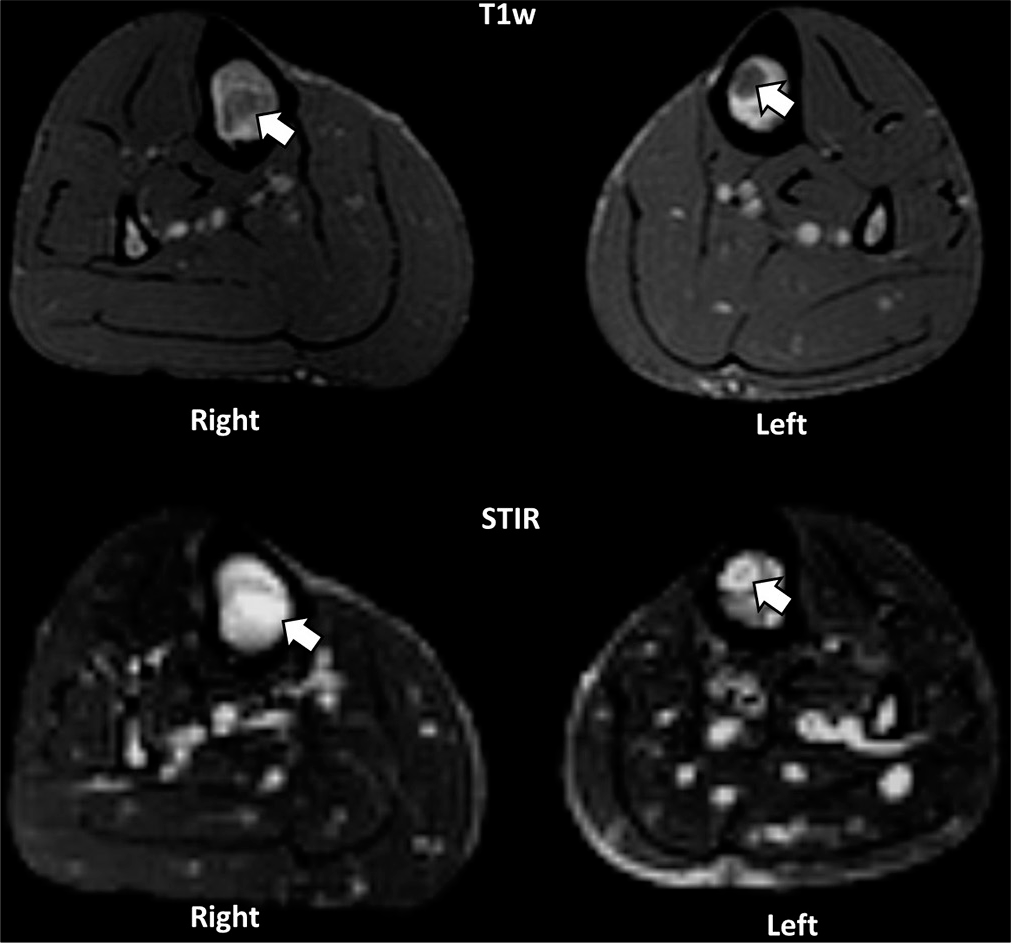Axial T1w and STIR images demonstrate abnormal marrow signal (white arrows) in both tibias, confirming a bilateral distribution of the lesions.