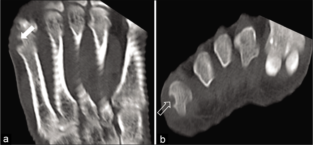 Computed tomography images of the right foot in coronal (a) and axial (b) planes in bone window showing the subchondral location of the lesion surrounded by a thin rim of sclerosis (solid white arrow in a). Laterally, there is a smooth cortical defect (void white arrow in b) with overhanging margin.