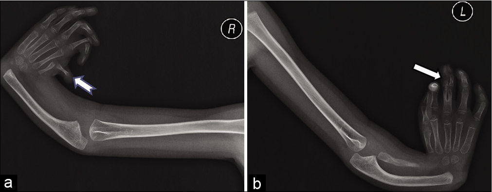 (a) Anteroposterior (AP) radiograph of the right upper limb showing absent radius and distal phalanx of thumb (notched arrow), radial deviation of hand with a perpendicular orientation of hand with respect to the forearm, and delayed ossification of carpal bones. (b) AP radiograph of the left upper limb showing hypoplastic radius, bowing of ulna, radial deviation of hand with a perpendicular orientation of hand with respect to the forearm, delayed ossification of carpal bones, elongated 2nd metacarpal, and synpolydactyly of 3rd digit (solid arrow).