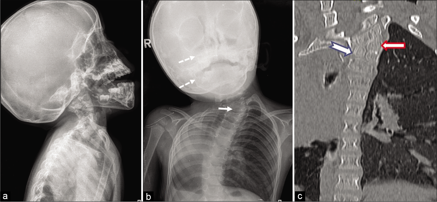 Radiographs of the skull with cervical spine (a) anteroposterior view and (b) lateral view showing asymmetry of facial bones (maxillary sinus and mandible – dotted arrows), S-shaped scoliosis of the cervicothoracic spine and hemivertebra of T3 (arrow) (c) coronal multiplanar reconstruction image of the cervicothoracic spine showing T3 hemivertebra (solid arrow) and T4 butterfly vertebra (notched arrow).