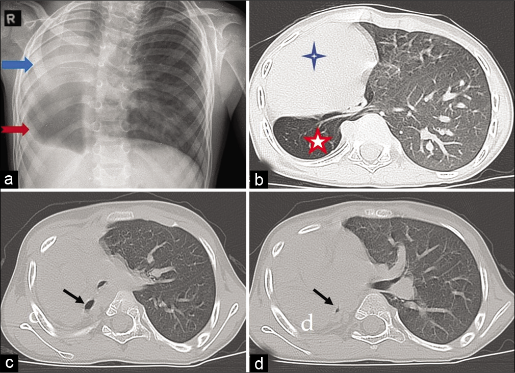 (a) Chest X-ray anteroposterior view showing a shift of heart and mediastinum to the right hemithorax (blue solid arrow), and radiolucency in the right mid and lower zones (red notched arrow). (b-d) High-resolution computed tomography scan of thorax showing dextrocardia (blue 4-point star)and herniation of the left lung to the right hemithorax behind heart (red 5-point star), blind-ending right main bronchus, and agenesis of the right lung (black arrows).