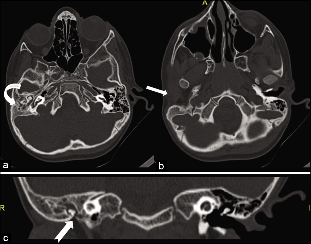 High-resolution computed tomography of temporal bone axial sections showing (a) dysplastic right middle ear cavity and non-pneumatization of the right mastoid air cells (curved arrow) (b) absent right external auditory canal (solid arrow) (c) coronal reconstructed view showing small tympanic cavity with dysplastic ossicles (notched arrow).