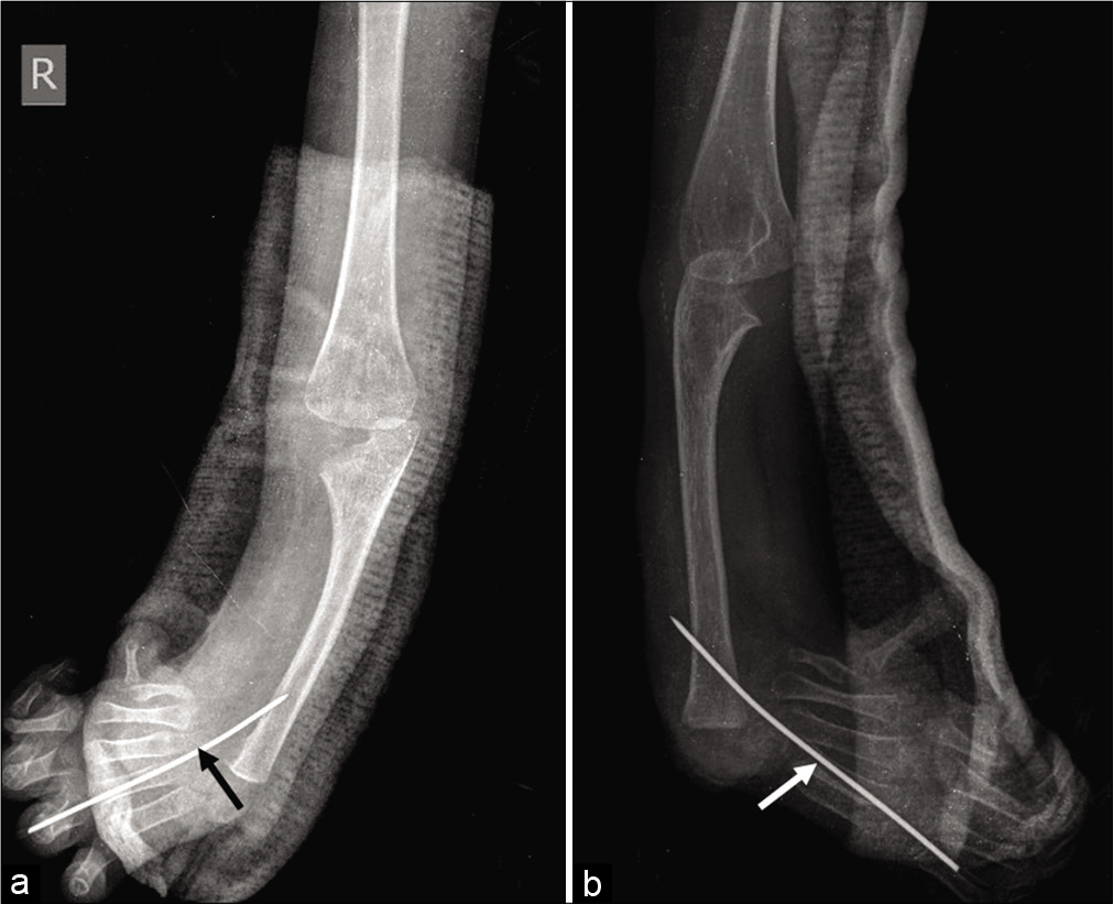 X-ray right forearm (a) anteroposterior and (b) lateral views post-centralization procedure showing K-wire in situ passed through the 4th metacarpal to restore carpus in line with the ulna.