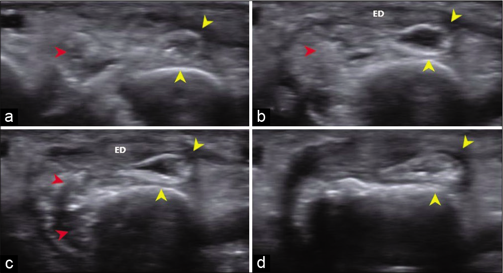 (a-d) Local USG – axial sections from proximal to distal, shows a partially collapsed fluid-filled dorsal bursa with thickened wall (yellow arrow heads). Radial aspect of the bursal wall is poorly delineated. An ill-defined heterogeneous lesion with echogenic areas within corresponding to the calcific inflammatory infiltrate (red arrow heads) is noted in the periarticular location along the radial aspect of the fourth metacarpal bone. Extensor digitorum (ED) tendon appeared normal.